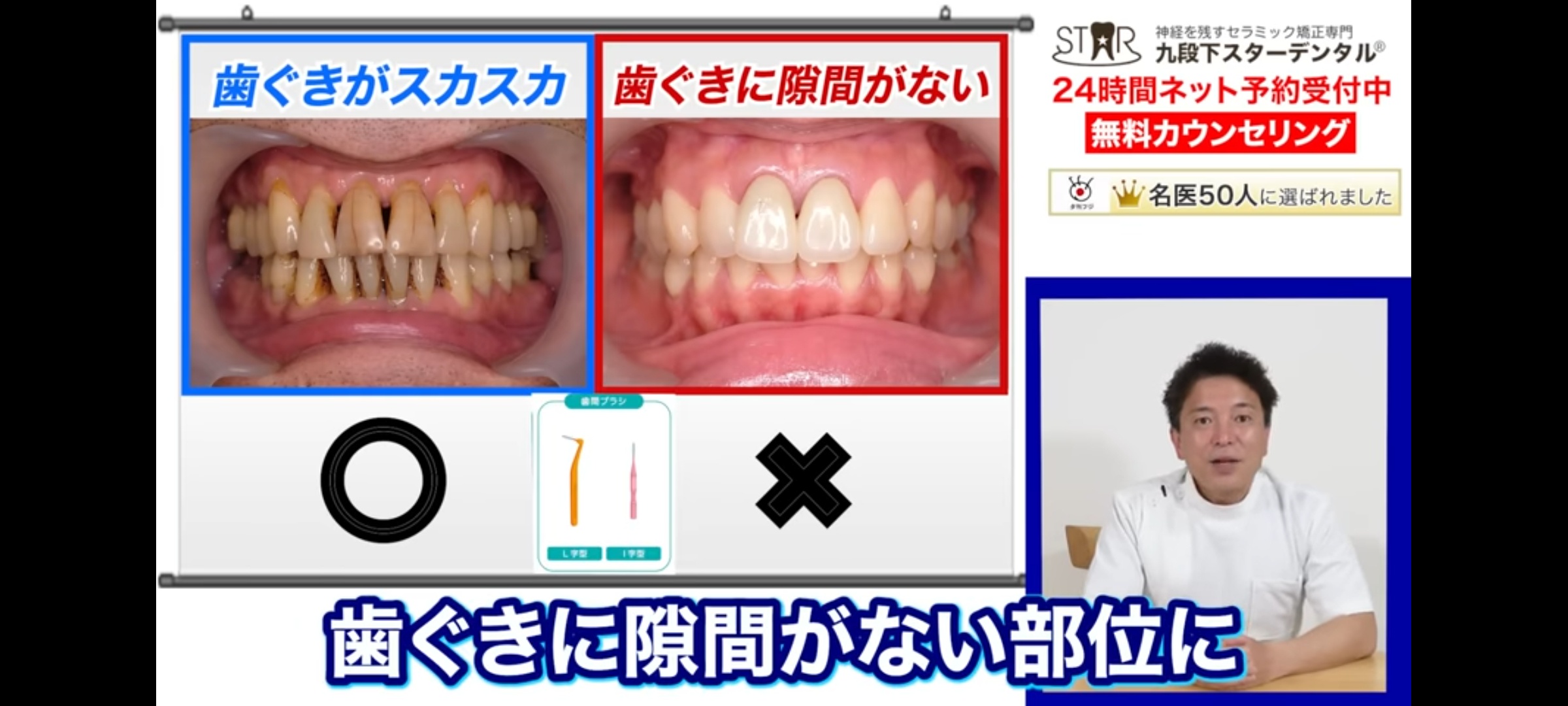 【画像】歯科医師「歯間ブラシは絶対に使うな！」